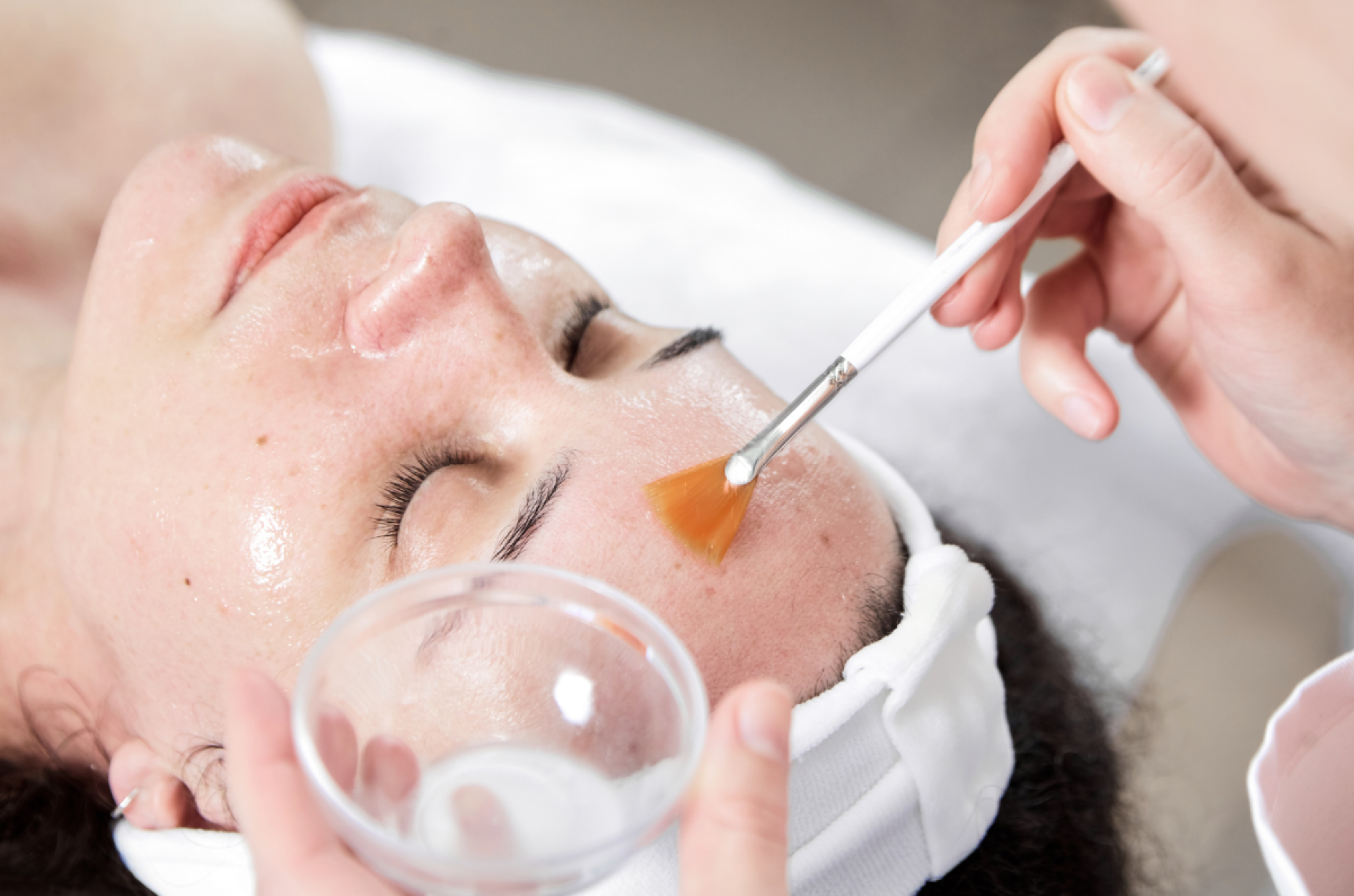 Chemical Peel